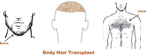 Body Hair Transplant to Head Results in India - Rejuvenate BHT | Hair ...