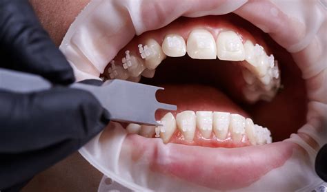 Veneer Care Guide: How to Maintain a Long-Lasting Smile