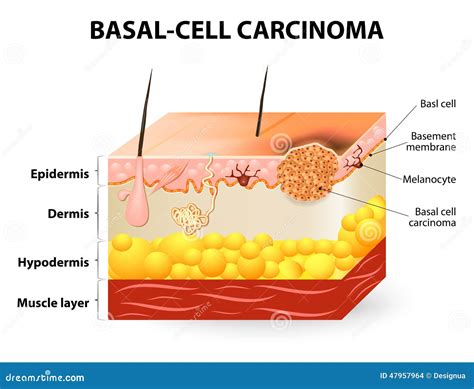 Skin Cancer. Squamous Cell Carcinoma, Basal-cell Cancer And Melanoma. Cartoon Vector ...