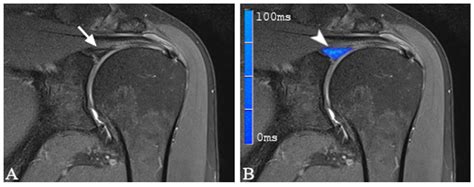3-Tesla T2 Mapping Magnetic Resonance Imaging for Evaluation of SLAP ...
