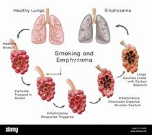 emphysema 的图像结果