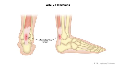Achilles Tendonitis - Locke Minor Foot Surgery & Orthotics