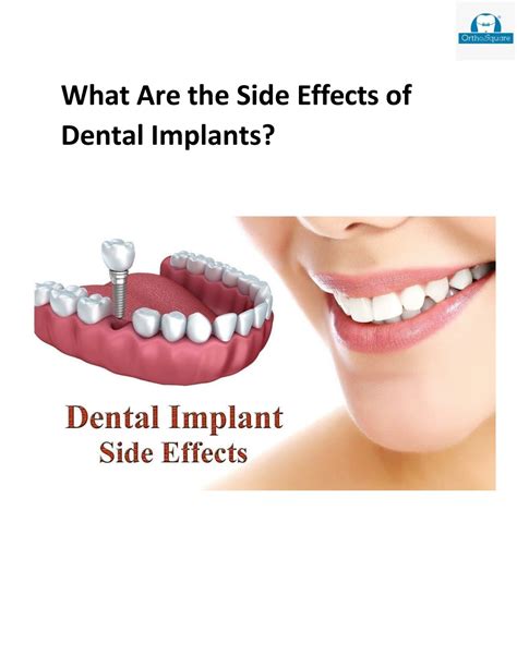 PPT - What Are the Side Effects of Dental Implants PowerPoint ...
