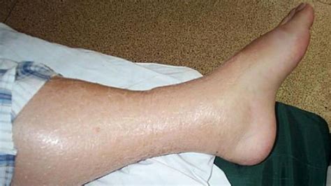What Causes Swollen and Hot Leg? | New Health Advisor