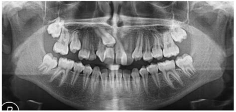 Transposed Maxillary Canines: Narrative Review with Clinical Case Report