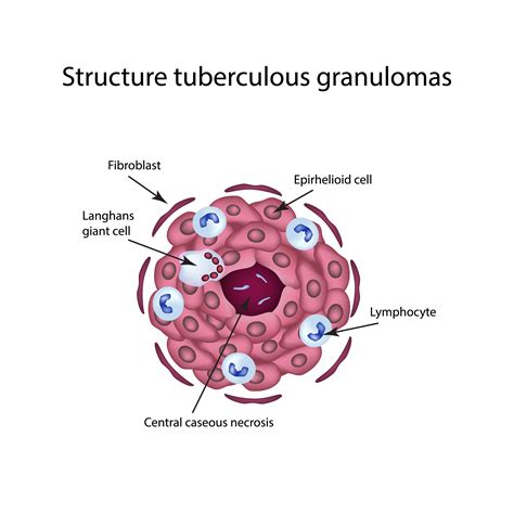 TB Structure