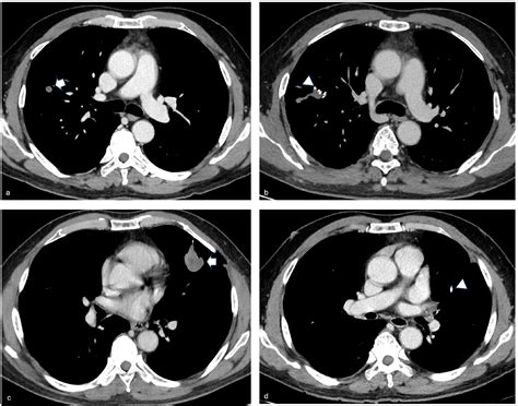 Surgical Management of Intrathoracic Triton Tumors: Insights into ...