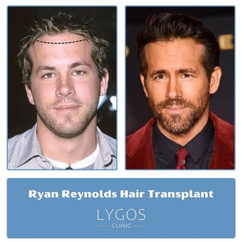 Ryan Reynolds Hair Transplant | Before And After | LYG 2025