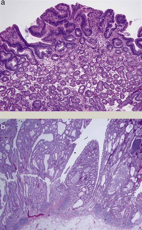 Adenomatous and serrated polyposis syndromes - Diagnostic Histopathology