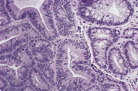 Barrett Esophagus - Clinical Tree