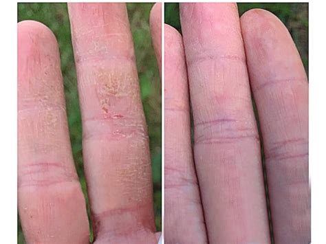 Relieve dry skin symptoms with Cutemol Emollient Cream 8 oz Jar.