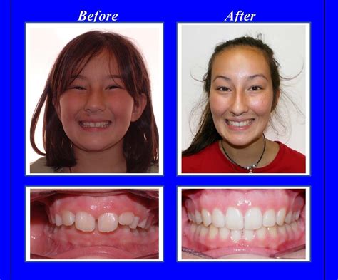 Overbite Correction Braces