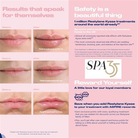 Before And After Photos Juvederm In Lips Cost | Lipstutorial.org