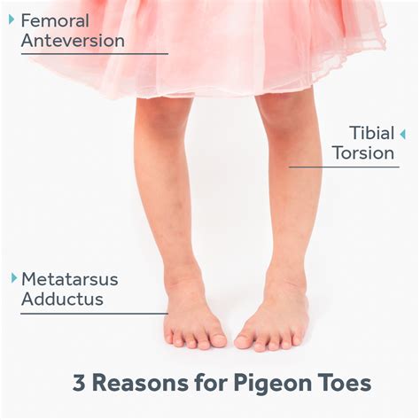 Pigeon Toed Meaning