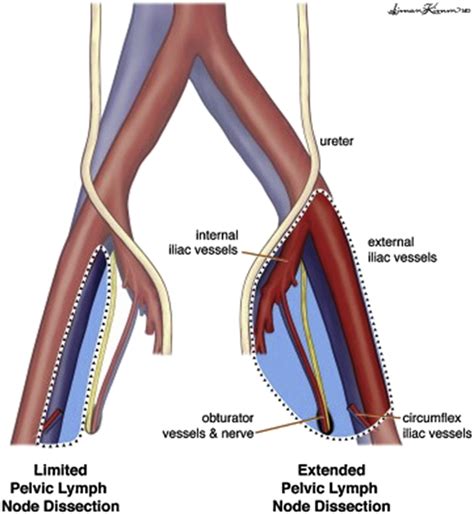 Lymph Node Dissection