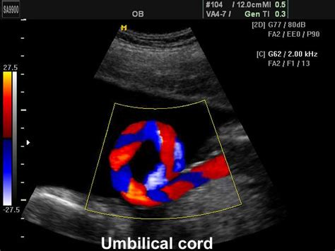 Bildergebnis für umbilical cord ultrasound images