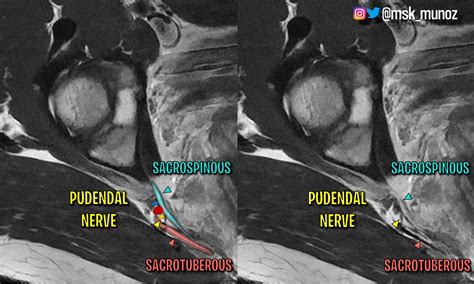 Pudendal Nerve Mri