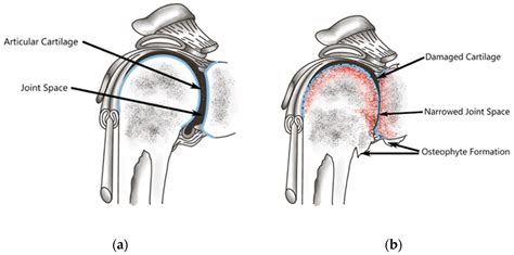 Glenohumeral Osteoarthritis: A Biological Advantage or a Missed Diagnosis?