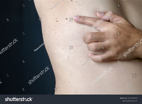 Closed Skin Tags Acrochordon Under Armpit Stock Photo 2137329123 ...
