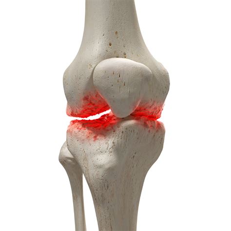 Can you reverse arthritis?