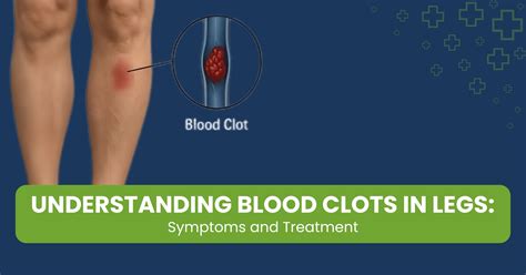 Blood Clots in Legs: Symptoms and Treatment Options - Palos Healthcare ...