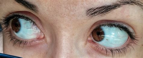The eyes have it... : r/ehlersdanlos