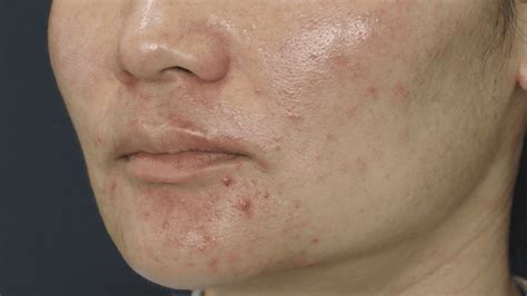 Spectra Carbon Peel | The Face Bar Laser Clinic Sydney