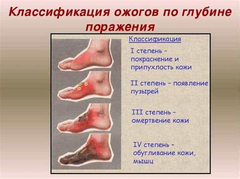Ожоги – как лечить, фото и схема разных степеней ожогов. Первая помощь
