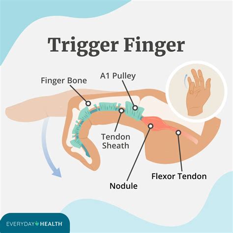 Trigger Finger Definition Etiology Symptoms Diagnosis Evaluation And