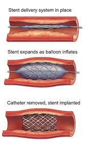 Stent: Hebrew translation, meaning, synonyms, antonyms, pronunciation ...