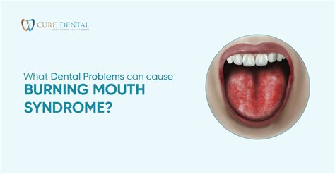 Burning Mouth Syndrome: Causes, Treatment & Symptoms | Cure Dental