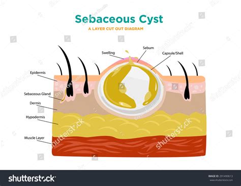 Sebaceous Cyst
