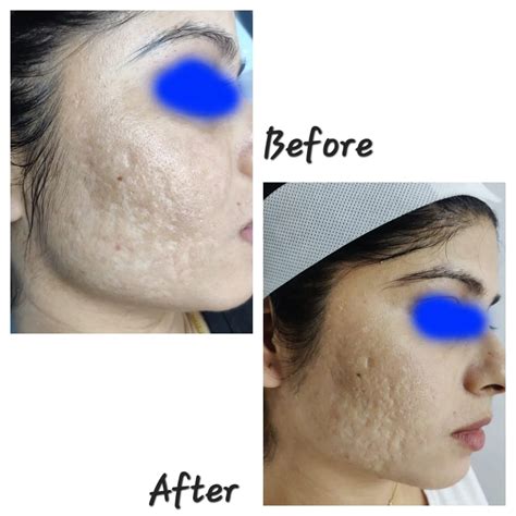 Best Acne Scars Treatment in Kolkata - Cost, Procedures & Results - La Derma