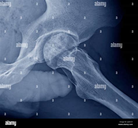 Painful hips, X-ray Stock Photo - Alamy