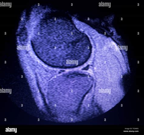 Magnetic resonance imaging MRI knee posterior horn medial meniscus tear scantest results Stock ...