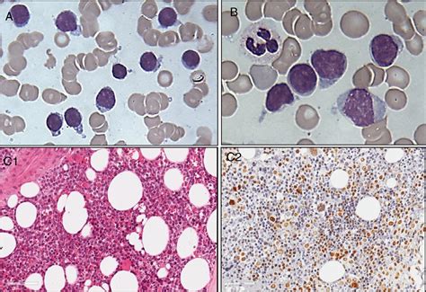 Plasma Cell Leukemia