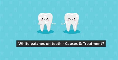White Patches on Teeth- Causes & Treatment?