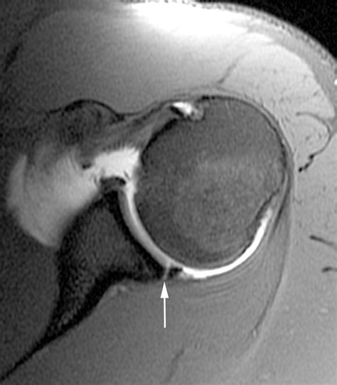 Increased Risk of Posterior Glenoid Labrum Tears in Football Players | AJR