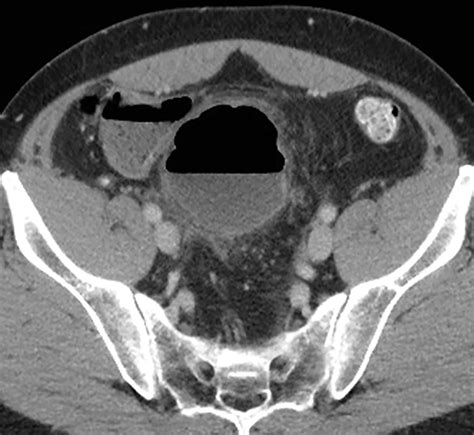 Giant Sigmoid Diverticulum: Imaging Features and Management | Applied Radiology