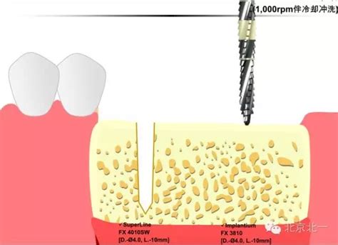 分享韩国登腾dentium种植体型号尺寸大全，了解您的种植牙的价格_皓齿口腔网