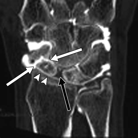 Scapholunate Advanced Collapse and Scaphoid Nonunion Advanced Collapse: MDCT Arthrography ...
