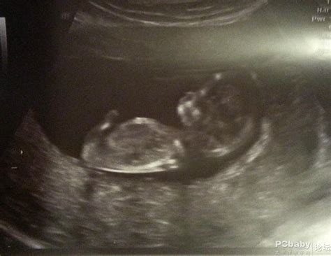 怀孕12周3个月B超，胎儿在动，惊喜不断！