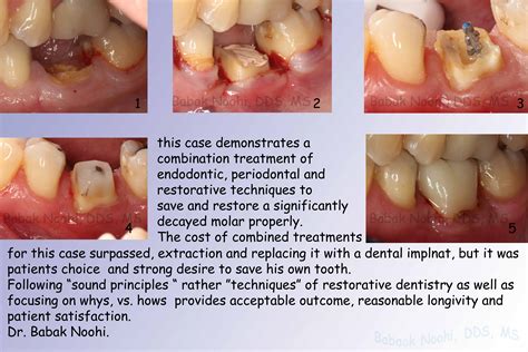 Tooth Pressure Under Crown at Piper Walton blog
