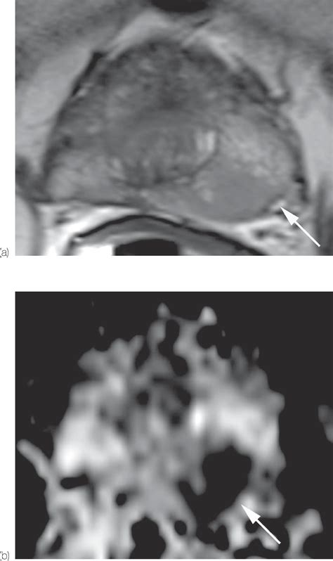 Reconciling discordance between PI-RADS 4 lesions and targeted biopsy: Early experience of a ...