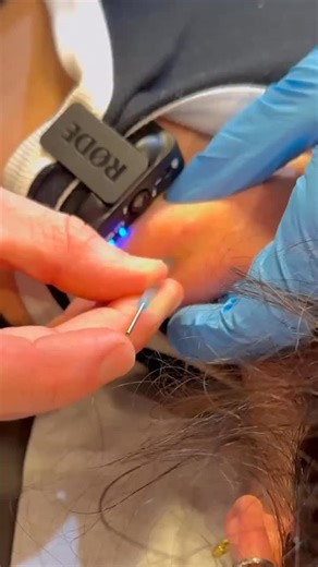 Dr. Kyle Ross on Instagram: "🏆 Dry needling targets trigger points to release deep muscle tension and improve mobility when stretching isn’t enough. #DryNeedling #DrKyleRoss #chiropractor"