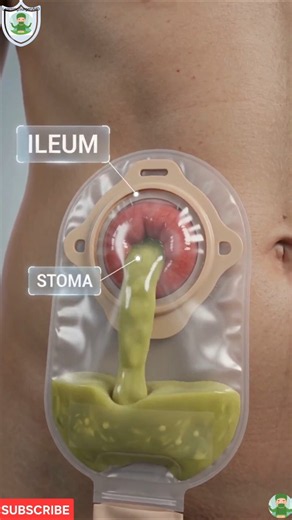 How an Ileostomy Works (3D Animation) 🤯