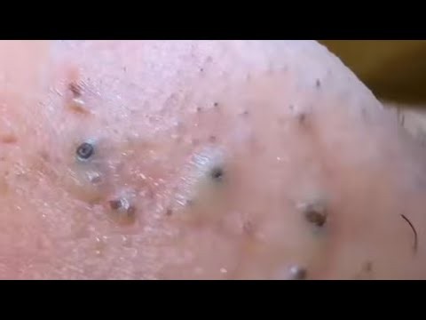 Deep blackhead Removal 2026, acne removal spa, big pimple 2026, #acne #pimple #cyst