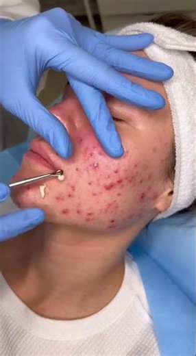 Relax Everyday With Sac Dep Spa Blackheads | Gigantic Blackhead Removal | Dep Sac Spa #146