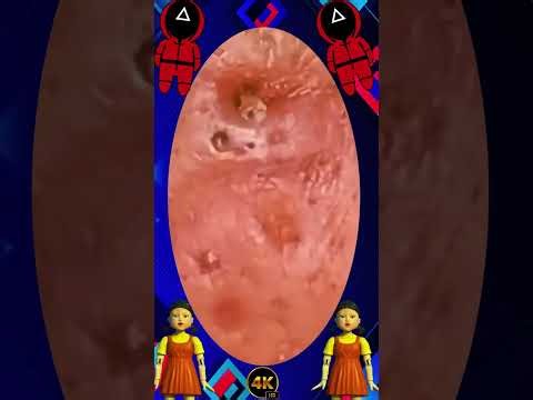 Satisfying Blackhead Removal | Acne Treatment, Pimple Pop & Deep Skin Clean-Up