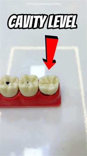 Cavity Level 😱